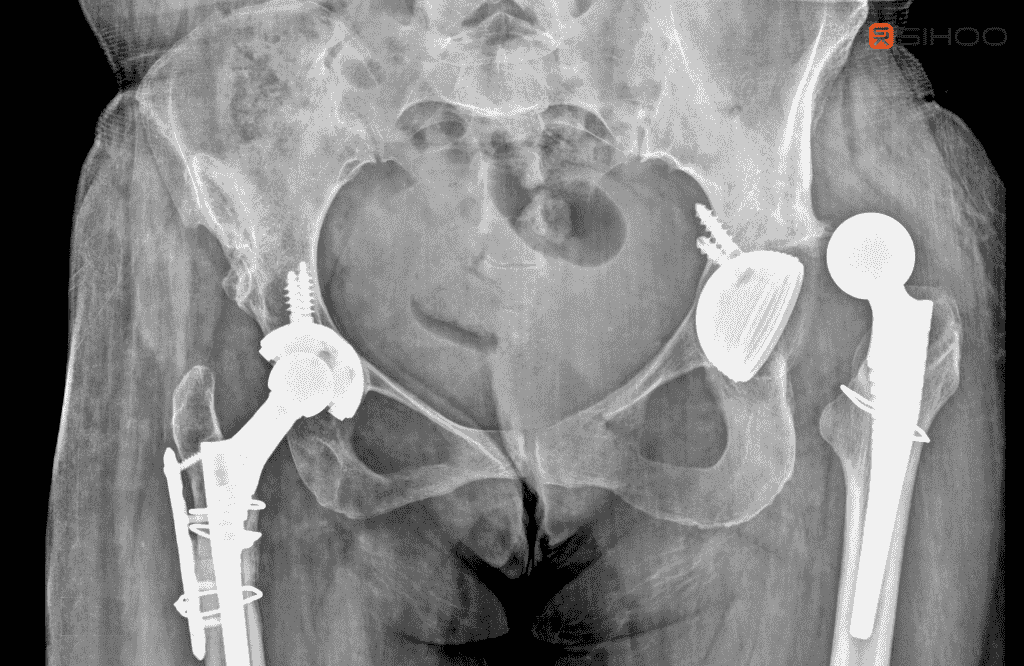 Übermäßiges Sitzen: So vermeidest du Hüftfehlstellungen